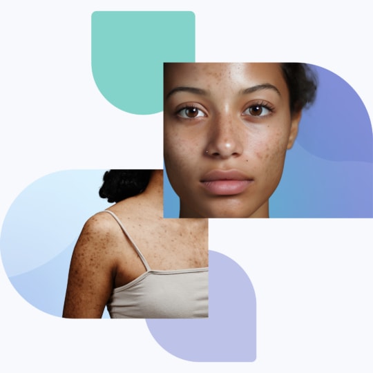 hyperpigmentation-treatment-540x540